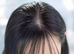 為什么頭皮出油很多